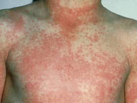 After 12 to 48 hours the characteristic fine red rash of scarlet fever develops