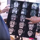 Lecanemab is designed to target and clear a protein called amyloid from patient’s brains (Photo: Adobe)