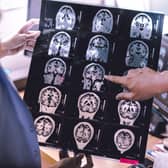 Lecanemab is designed to target and clear a protein called amyloid from patient’s brains (Photo: Adobe)