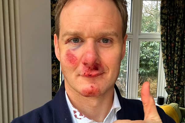 Dan Walker says he has no memory of the crash which left him bloody and bruised. Credit: Dan Walker