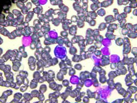 New treatment for children and adults with leukaemia (photo: Getty Images/iStockphoto)