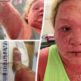 Woman's extreme allergic reaction to mosquito bite on holiday in the Caribbean 