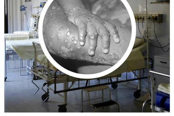 The WHO has declared a global health emergency over a mpox outbreak. (Photo: Pixabay, CDC/Getty Images)