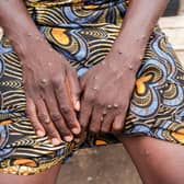 A woman infected with Mpox shows her arms at the Kamenge University Hospital's Mpox treatment centre in Bujumbura on August 22, 2024. (Photo: TCHANDROU NITANGA/AFP via Getty Images)