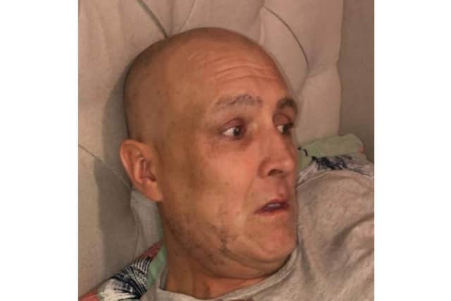 Paul after undergoing treatment