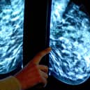 Generic stock picture of a mammogram showing a womans breast in order check for breast cancer at Derby City Hospital.