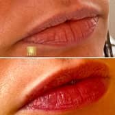 Subtle lip filler before and after