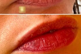 Subtle lip filler before and after