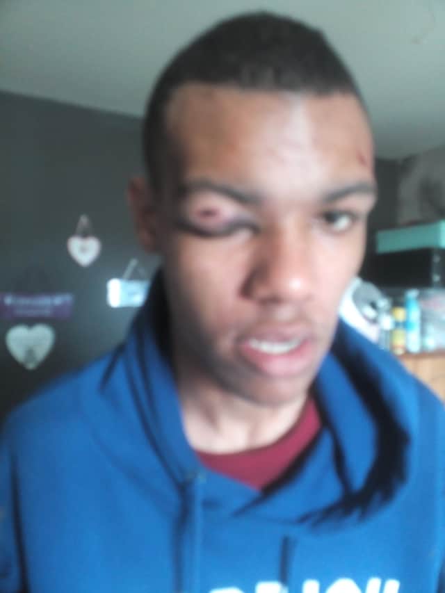 The teenager's injuries.