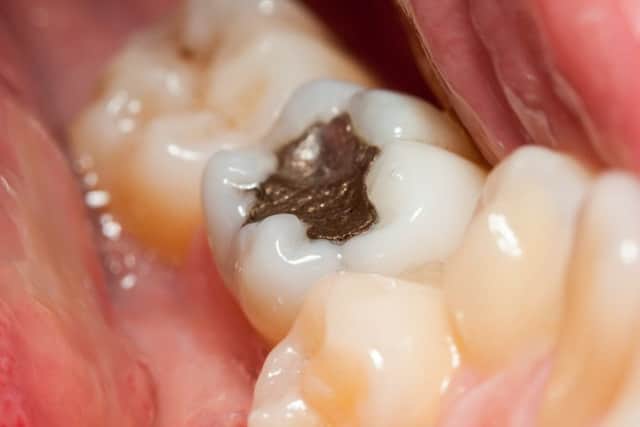 Fillings could be bad for your health