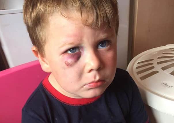 Corey Chesterton, four, after the attack